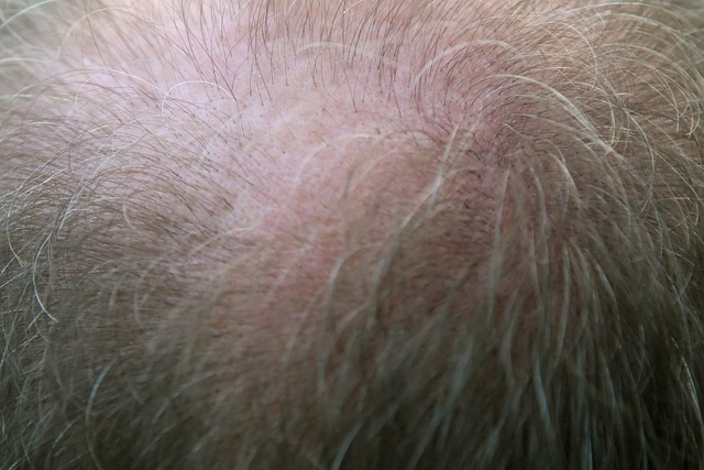 Greffe de cheveux ratée : comment faire ?
