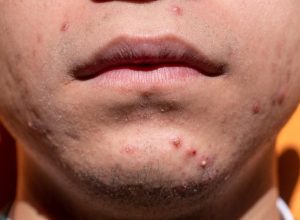 acne-6822174_1280